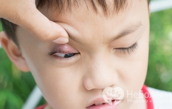 Пять заблуждений о лечении ячменя на глазу