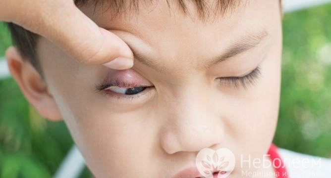 Пять заблуждений о лечении ячменя на глазу